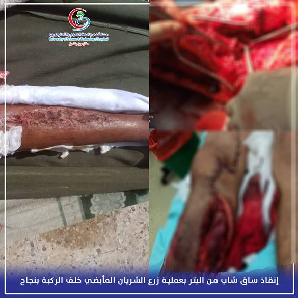 بعد أن قررت عدة مستشفيات بتر ساقه >>